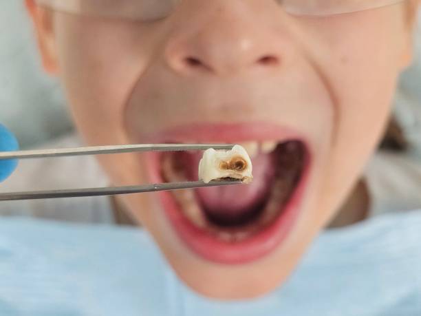Best Chipped Tooth Repair Near Me  in Highfill, AR